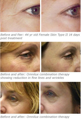 Omnilux facial treatments